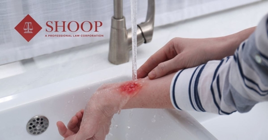 woman with burn on forearm